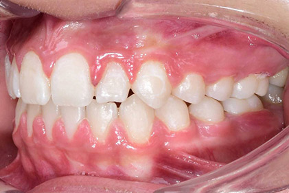 1007-2--بعد-از-درمان-ارتودنسی