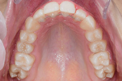 1007-3--بعد-از-درمان-ارتودنسی