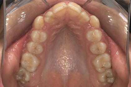 1007-3--قبل-از-درمان-ارتودنسی
