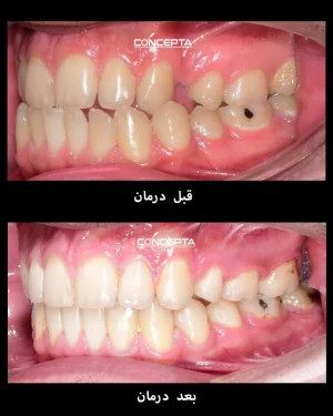 قبل و بعد از درمان به روش ارتودنسی ثابت دو فک، کلینیک دندان پزشکی کانسپتا